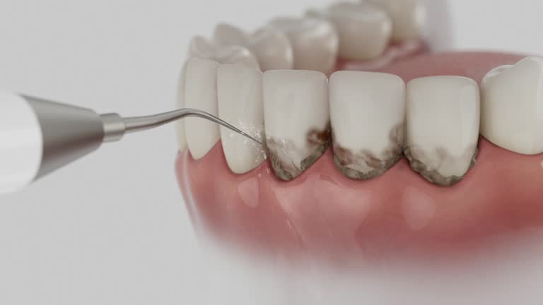 Trusted Dental Crowns And Bridges service in Stow, OH - Dentist Open Now